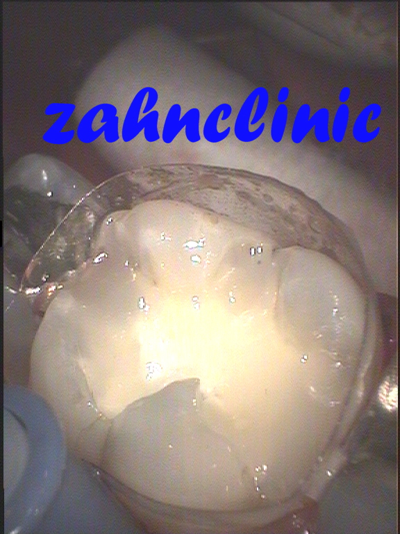 dentinadhaesive Befestigung